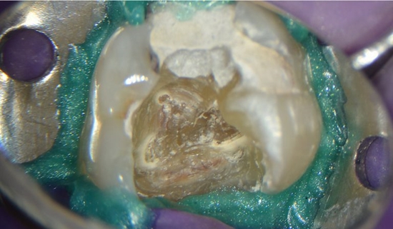 Locating-Calcified-Canals-1-768x449 