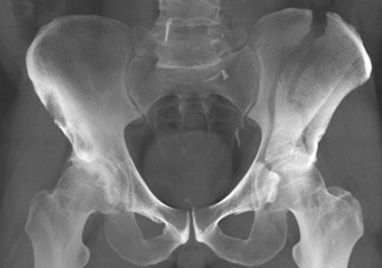 anteriorcolumn_1 