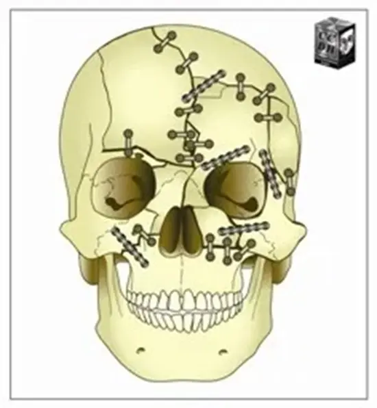 Skull-mended 