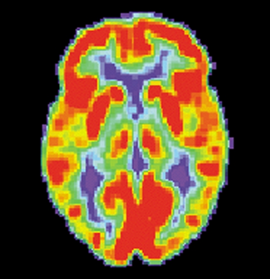 PET_Normal_brain 