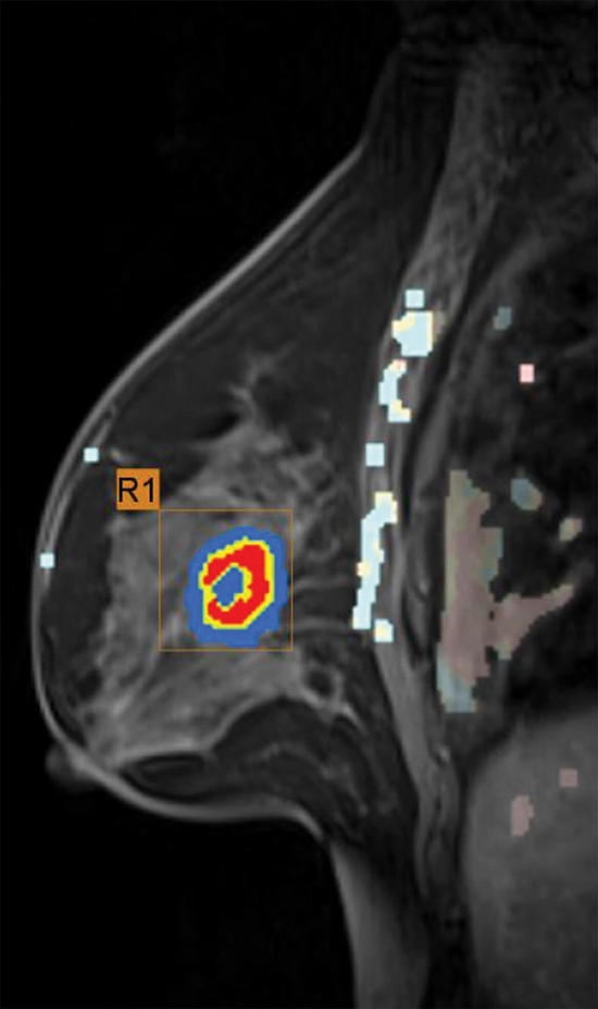 images_large_radiol.2020192039.fig2b 