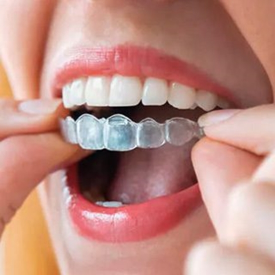 img-treatmentoption-01-invisalign 