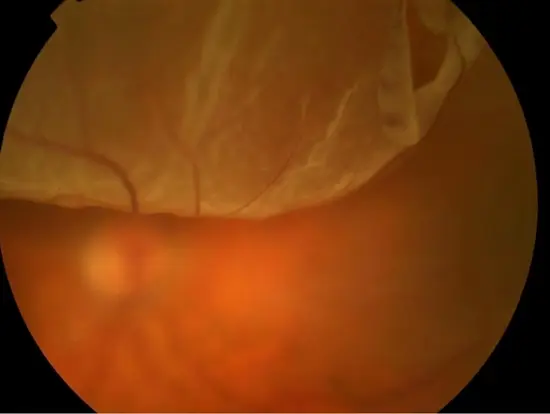 retinal-detachment-fundus-photo.jpg 