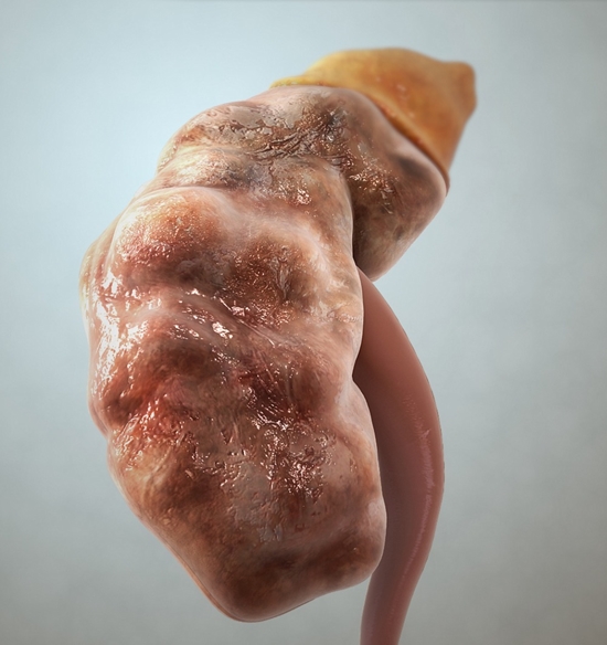 CKD_-_Chronic_kidney_disease 
