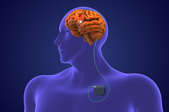 deep-brain-stimulation 