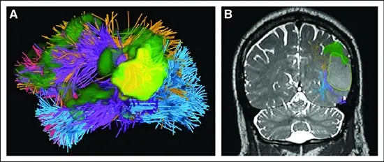 sualization-of-multimodal-diffusion-magnetic-resonance-imaging-MRI-and-functional-MRI 
