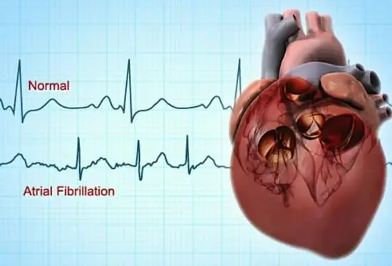 webmd_rf_photo_of_atrial_fibrillation 
